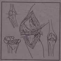 Image of The technique of total knee arthroplasty